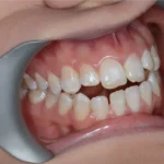 Резултат и лечение на отворена захапка