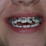 Снимка на отворена захапка и иползване на брекети